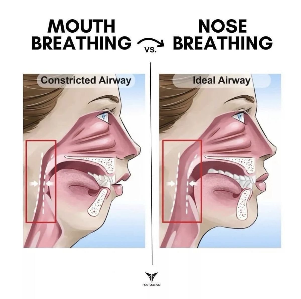 Mouth breathing vs nose breathing - constricted vs ideal airway