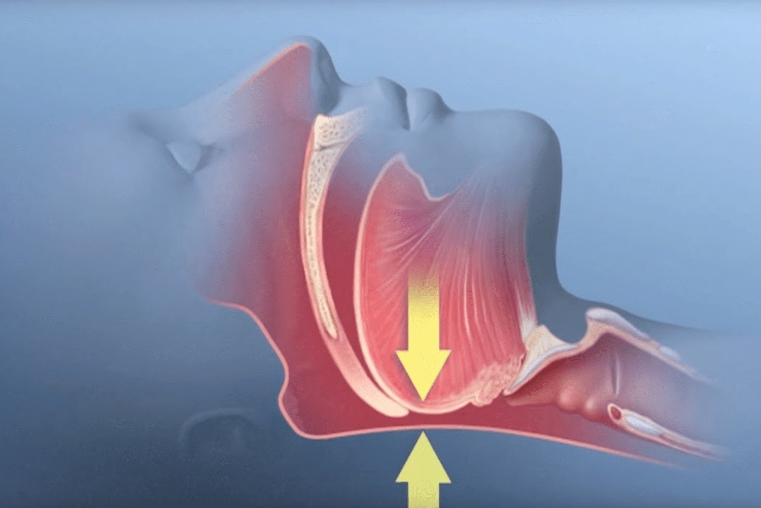 Tongue collapsing into the airway during sleep