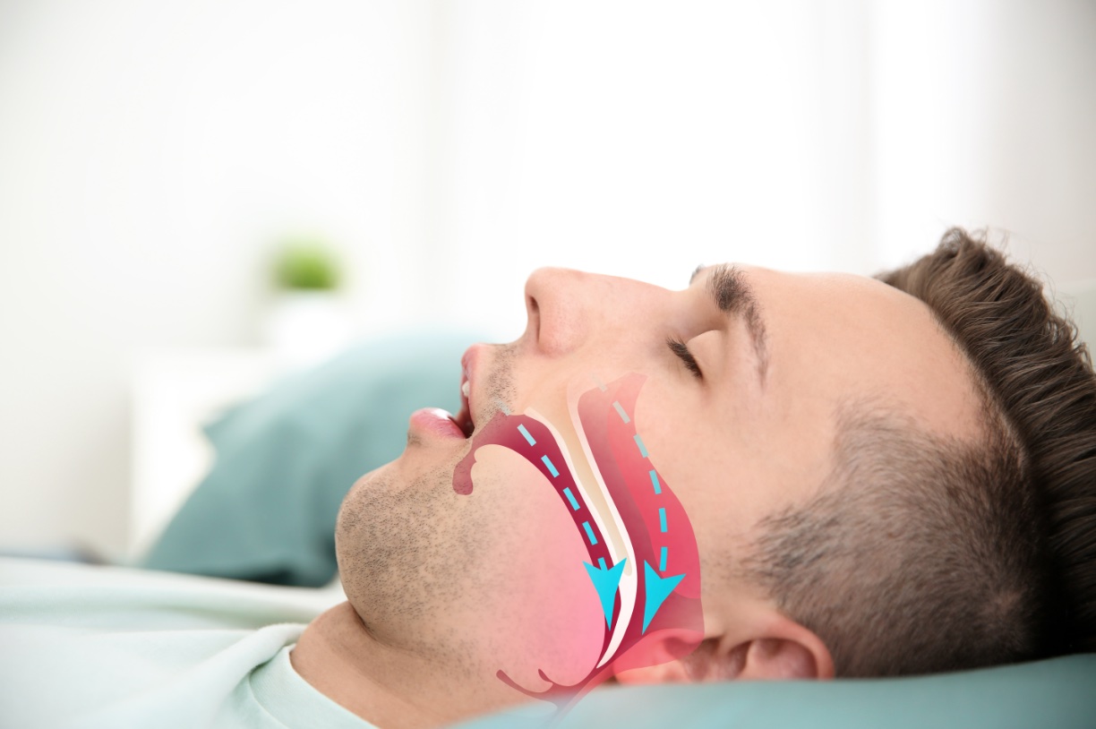 Illustration of airway collapsing during sleep
