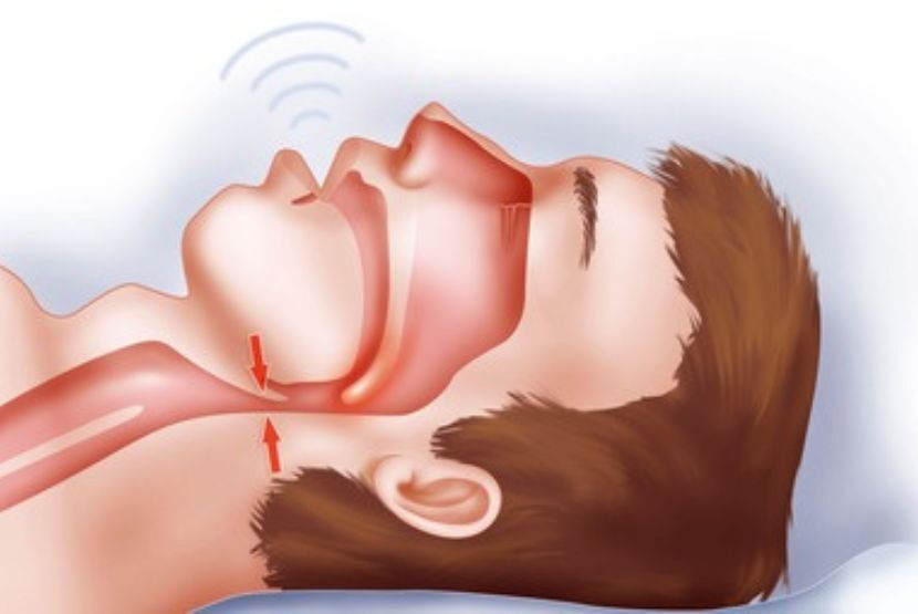 Diagram showing airway collapse and snoring during sleep